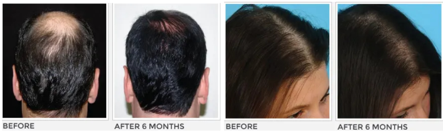 Hair restoration before and after Before and after hair restoration results